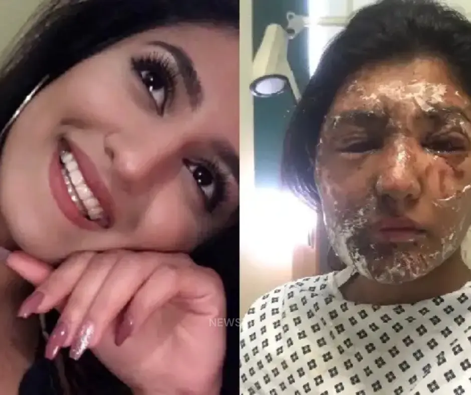Acid Attack Survivor Sapna’s 10-Year Legal Battle: From Pain to Rs 12 Lakh Justice Under DVCS and NALSA